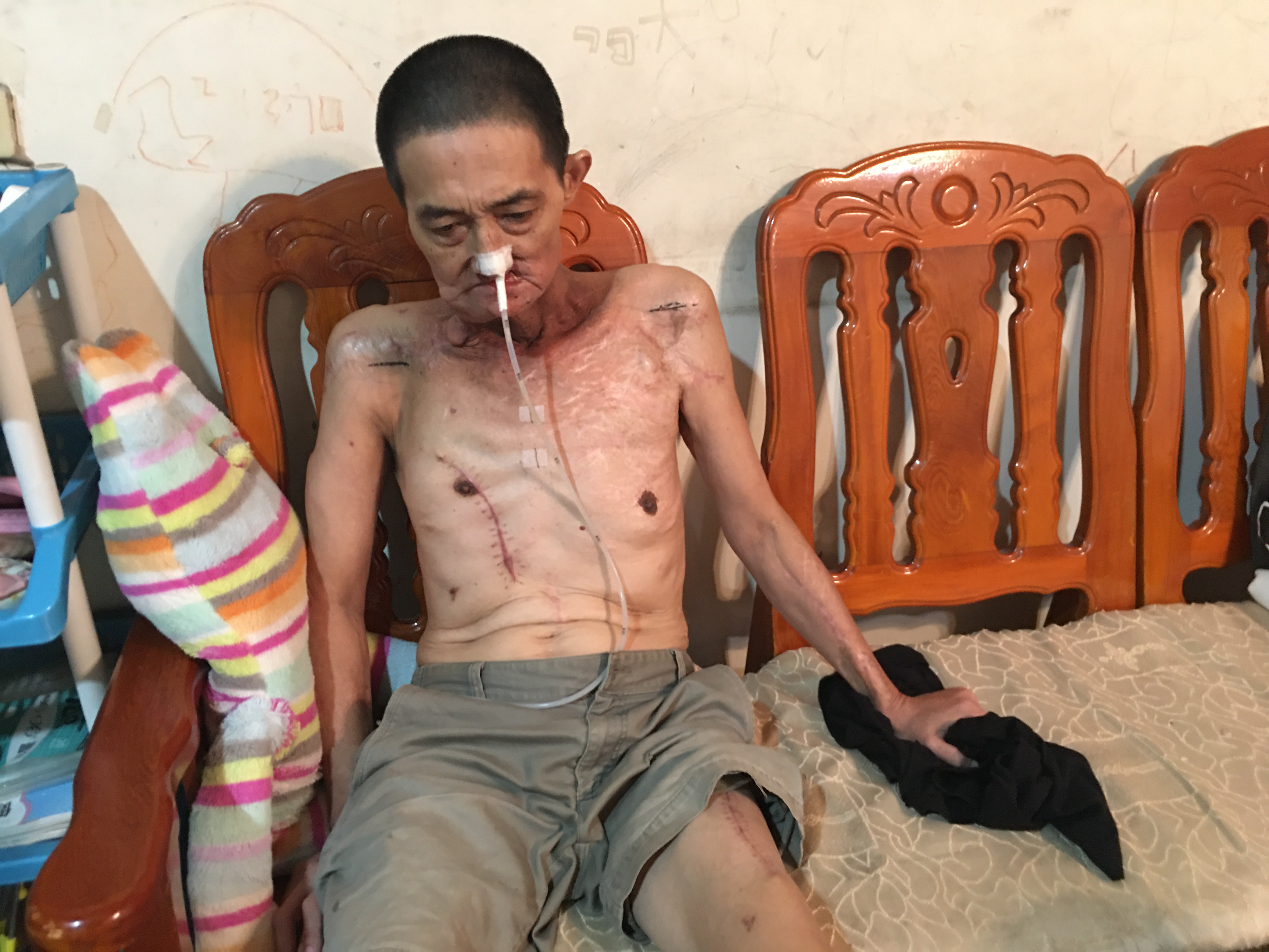 張峻庭臉頰及身上多處車禍及罹癌手術疤痕。向高彬攝 張峻庭臉頰及身上多處車禍及罹癌手術疤痕。向高彬攝