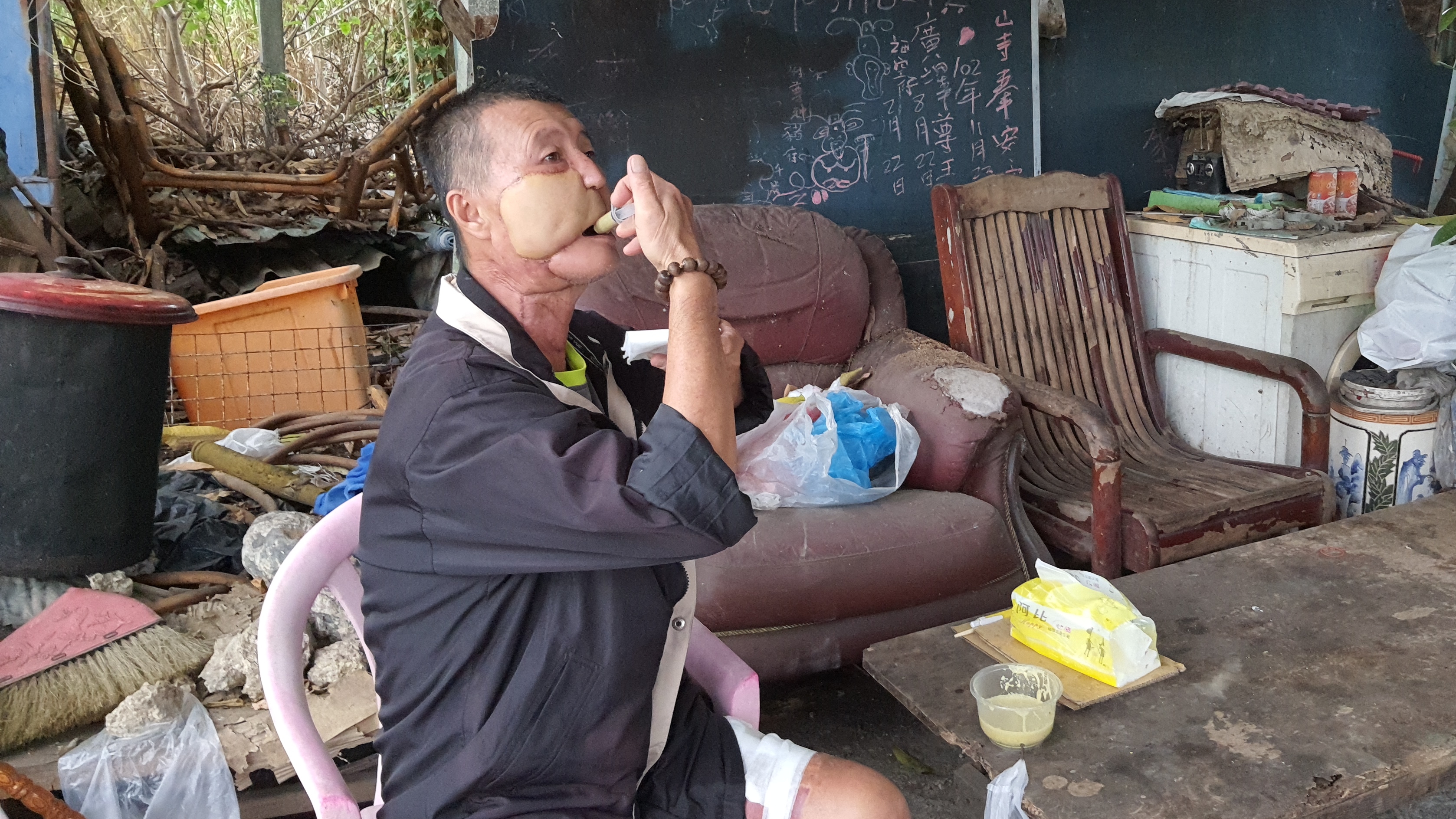 阿誠齒齦癌術後進行困難,只能啜飲流質食物,他正自己用針筒進食。韓旭爾攝 阿誠齒齦癌術後進行困難,只能啜飲流質食物,他正自己用針筒進食。韓旭爾攝
