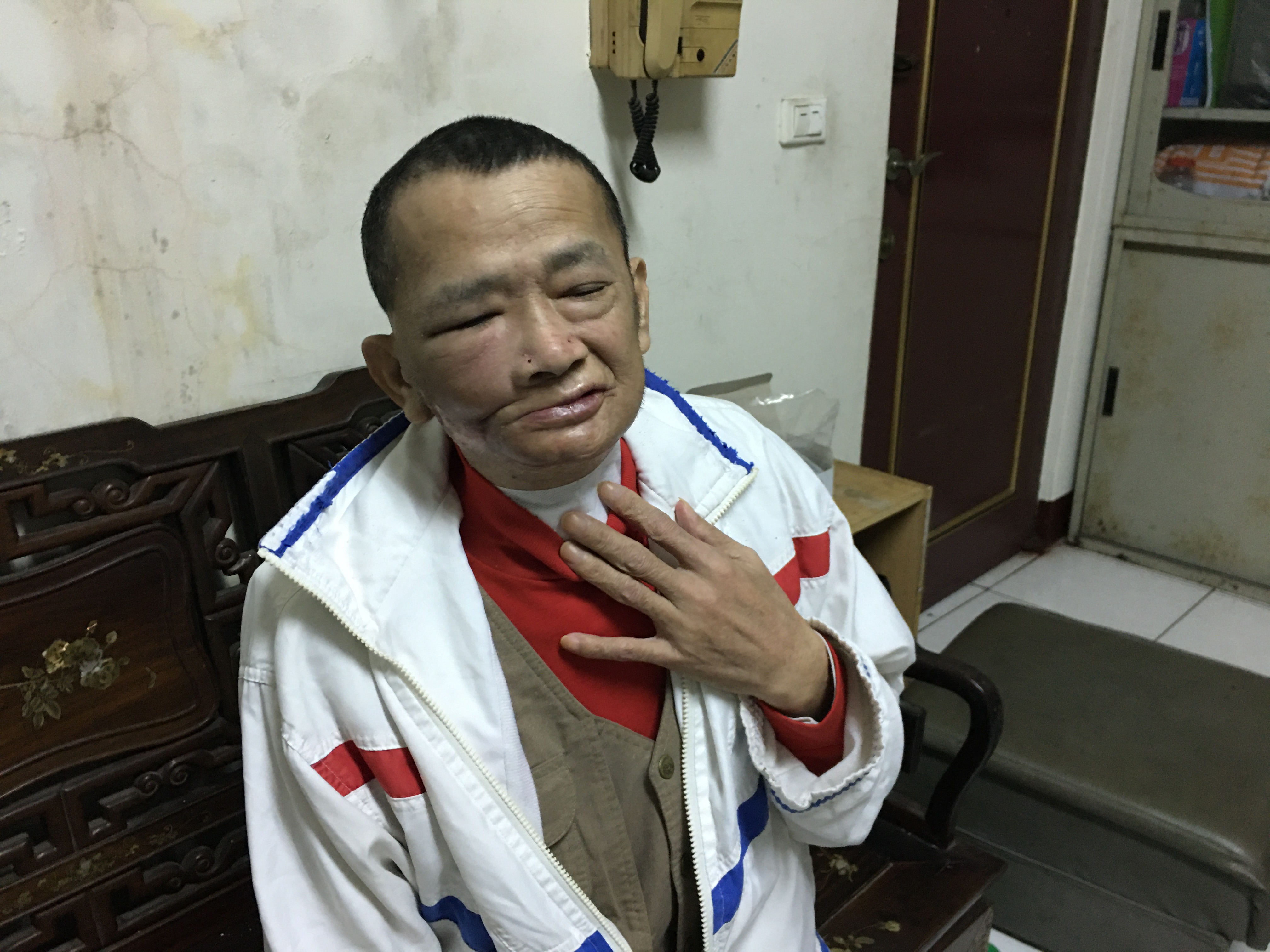 陳宗照抗癌經歷逾十次手術,右臉殘缺變形。向高彬攝 陳宗照抗癌經歷逾十次手術,右臉殘缺變形。向高彬攝
